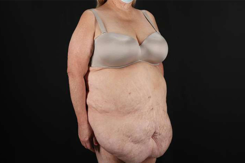 Fleur De Lis Circumferential Body Lift Before & After Patient #4199