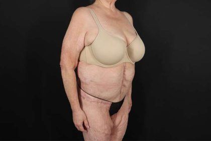 Fleur De Lis Circumferential Body Lift Before & After Patient #4199