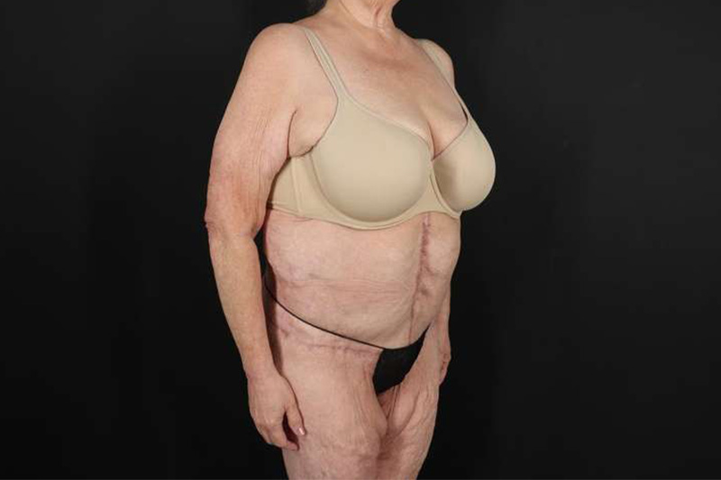 Fleur De Lis Circumferential Body Lift Before & After Patient #4199