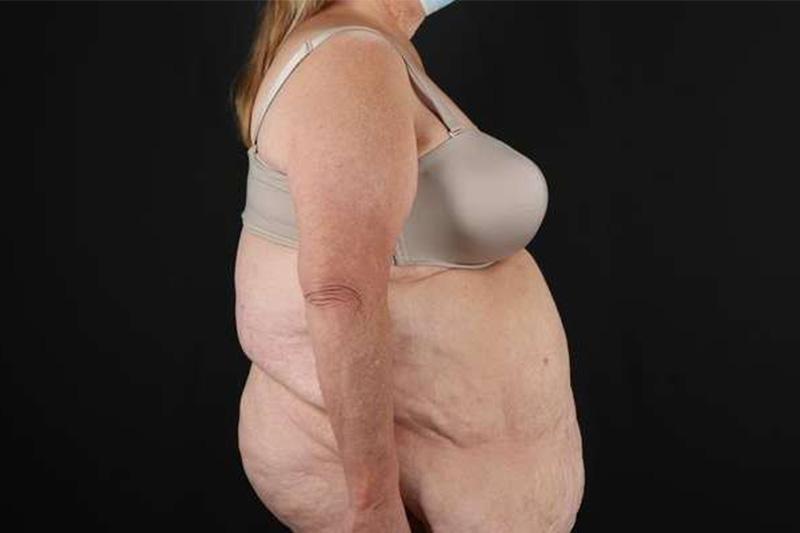 Fleur De Lis Circumferential Body Lift Before & After Patient #4199
