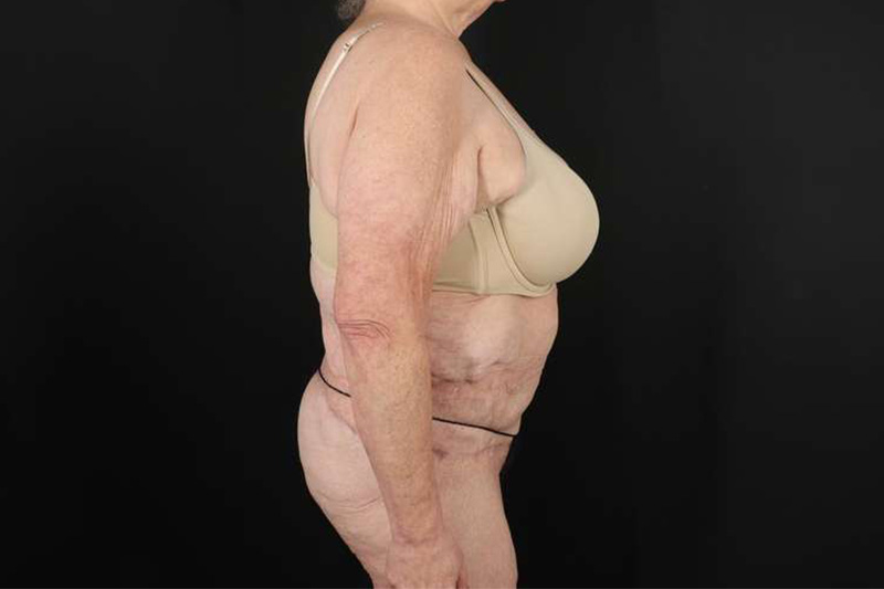 Fleur De Lis Circumferential Body Lift Before & After Patient #4199