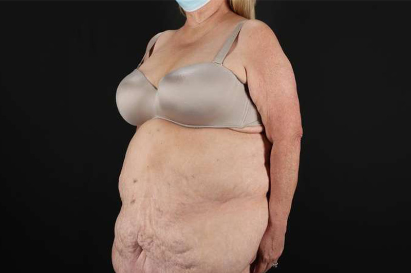 Fleur De Lis Circumferential Body Lift Before & After Patient #4199