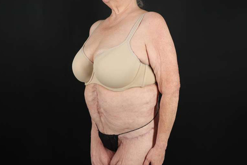 Fleur De Lis Circumferential Body Lift Before & After Patient #4199