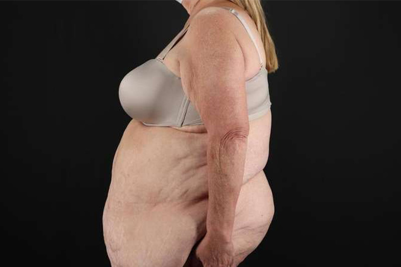 Fleur De Lis Circumferential Body Lift Before & After Patient #4199