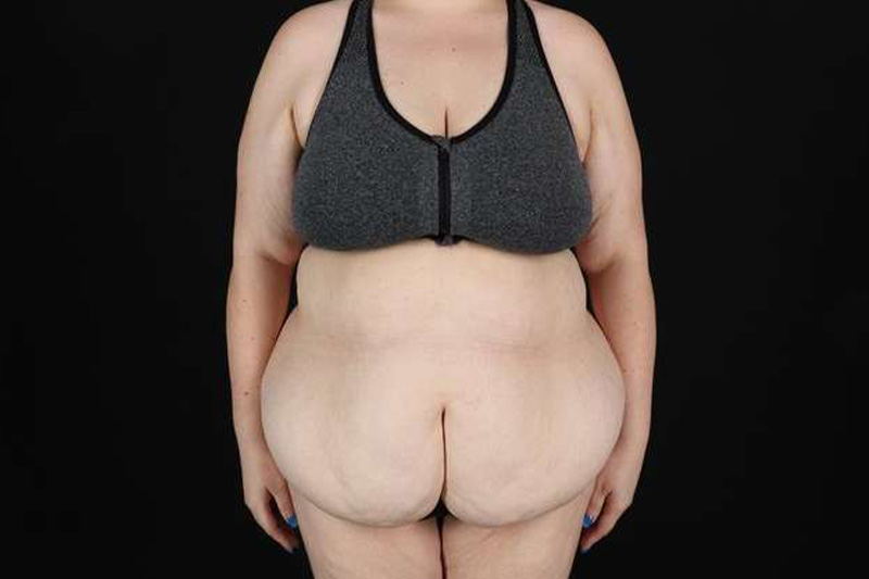 Fleur De Lis Circumferential Body Lift Before & After Patient #4223