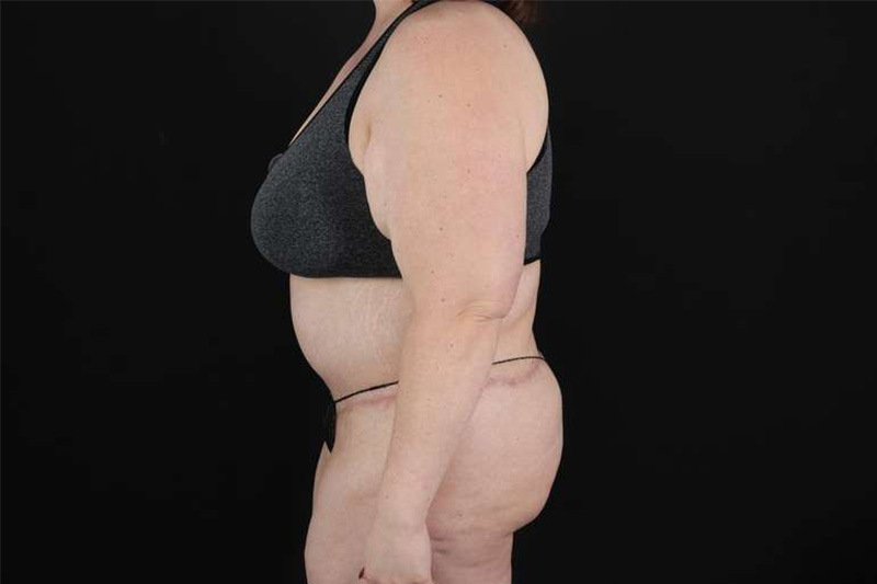 Fleur De Lis Circumferential Body Lift Before & After Patient #4223