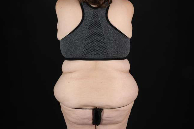 Fleur De Lis Circumferential Body Lift Before & After Patient #4223