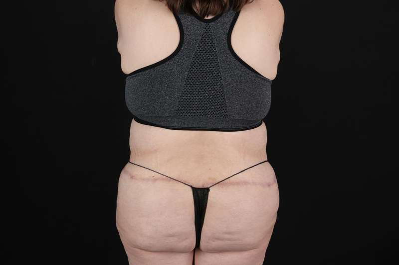 Fleur De Lis Circumferential Body Lift Before & After Patient #4223