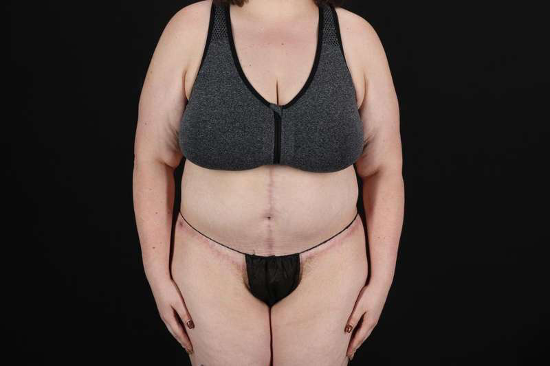 Fleur De Lis Circumferential Body Lift Before & After Patient #4223