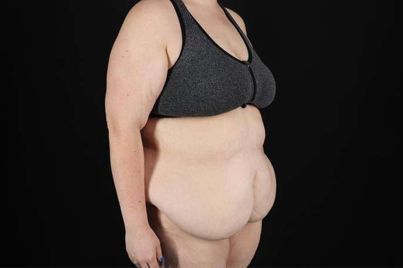 Fleur De Lis Circumferential Body Lift Before & After Patient #4223