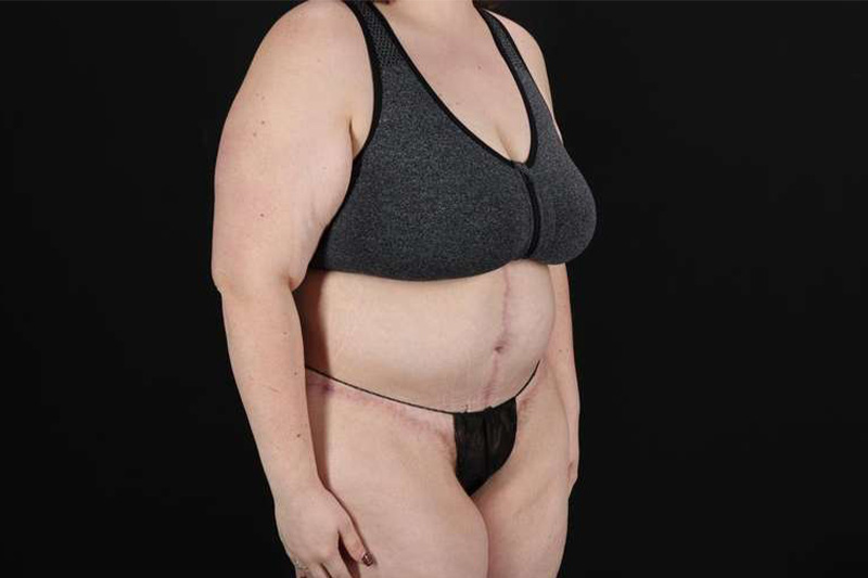 Fleur De Lis Circumferential Body Lift Before & After Patient #4223