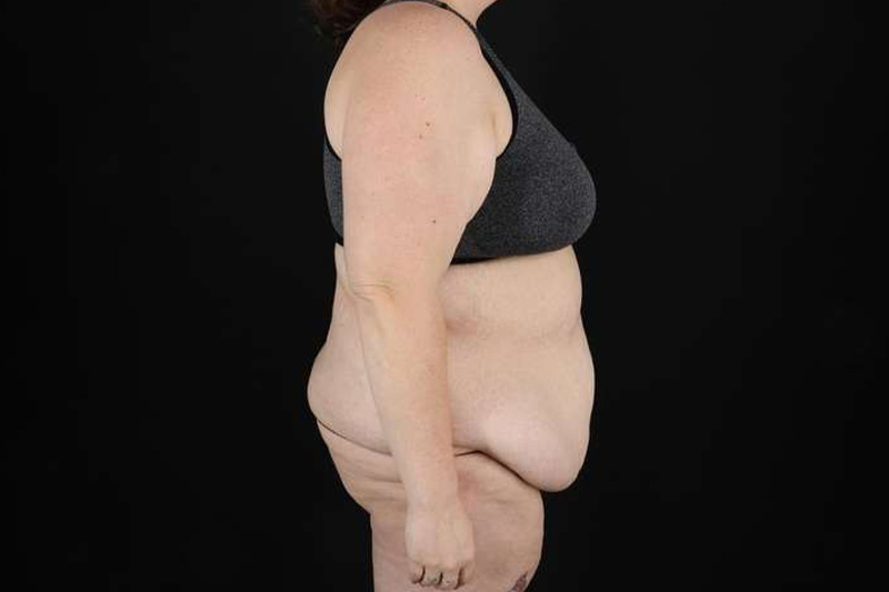 Fleur De Lis Circumferential Body Lift Before & After Patient #4223