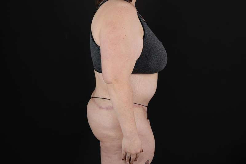 Fleur De Lis Circumferential Body Lift Before & After Patient #4223