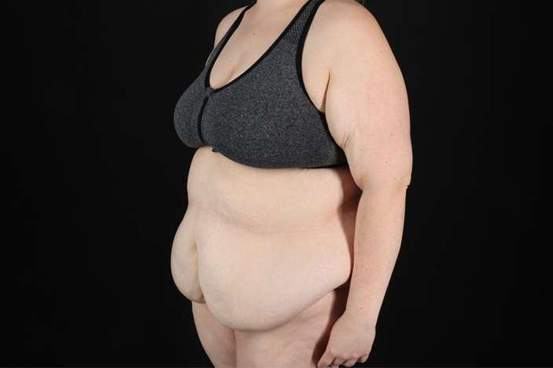 Fleur De Lis Circumferential Body Lift Before & After Patient #4223