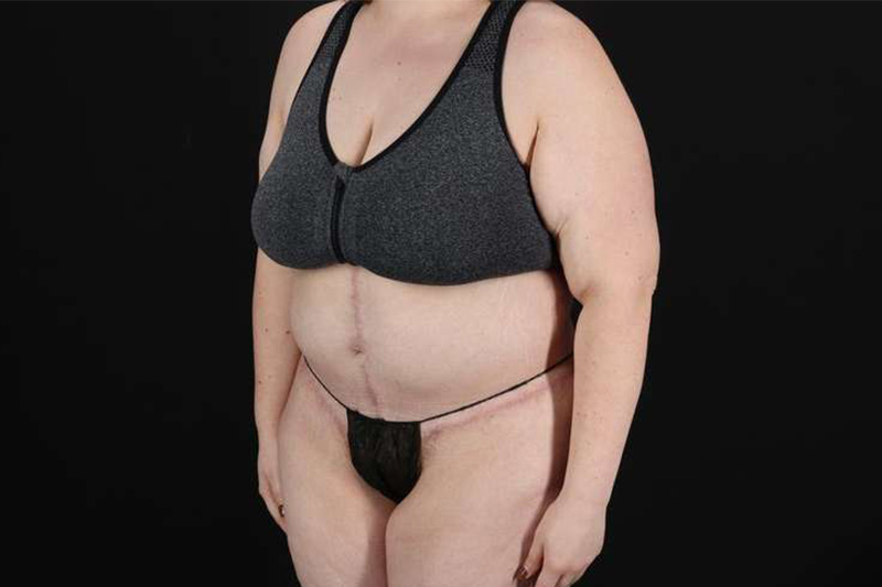 Fleur De Lis Circumferential Body Lift Before & After Patient #4223