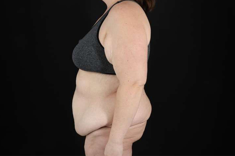 Fleur De Lis Circumferential Body Lift Before & After Patient #4223