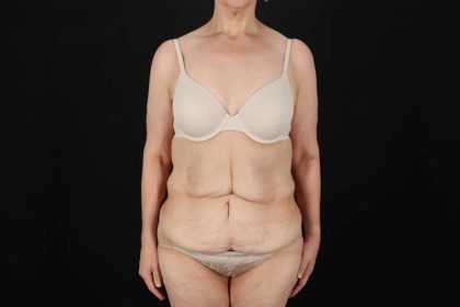 Fleur De Lis Circumferential Body Lift Before & After Patient #4249