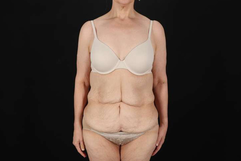 Fleur De Lis Circumferential Body Lift Before & After Patient #4249