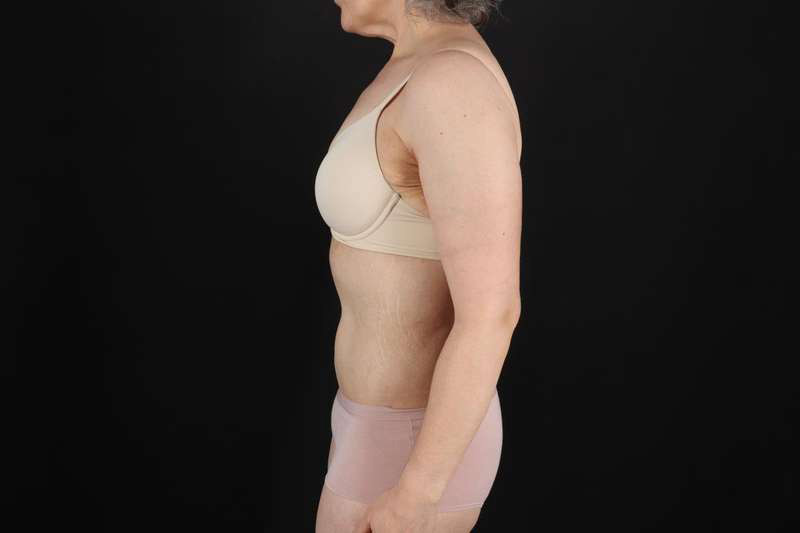 Fleur De Lis Circumferential Body Lift Before & After Patient #4249