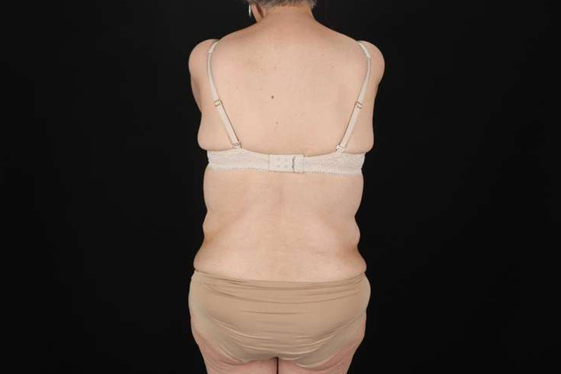 Fleur De Lis Circumferential Body Lift Before & After Patient #4249