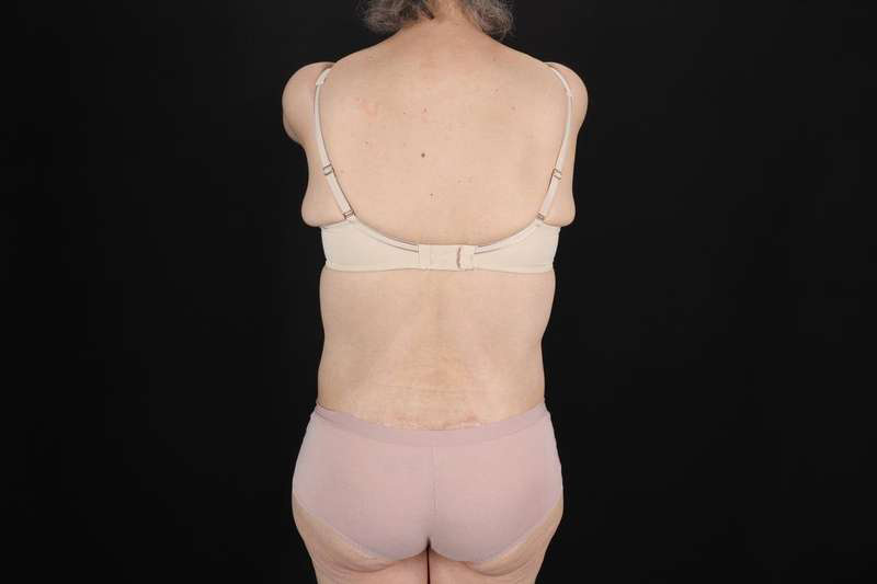Fleur De Lis Circumferential Body Lift Before & After Patient #4249