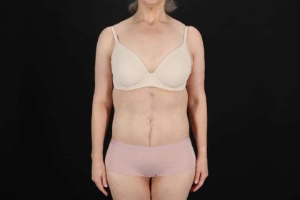 Fleur De Lis Circumferential Body Lift Before & After Patient #4249
