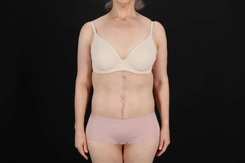 Fleur De Lis Circumferential Body Lift Before & After Patient #4249