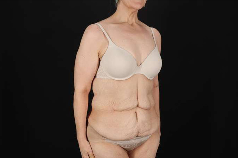 Fleur De Lis Circumferential Body Lift Before & After Patient #4249