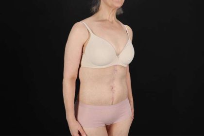 Fleur De Lis Circumferential Body Lift Before & After Patient #4249