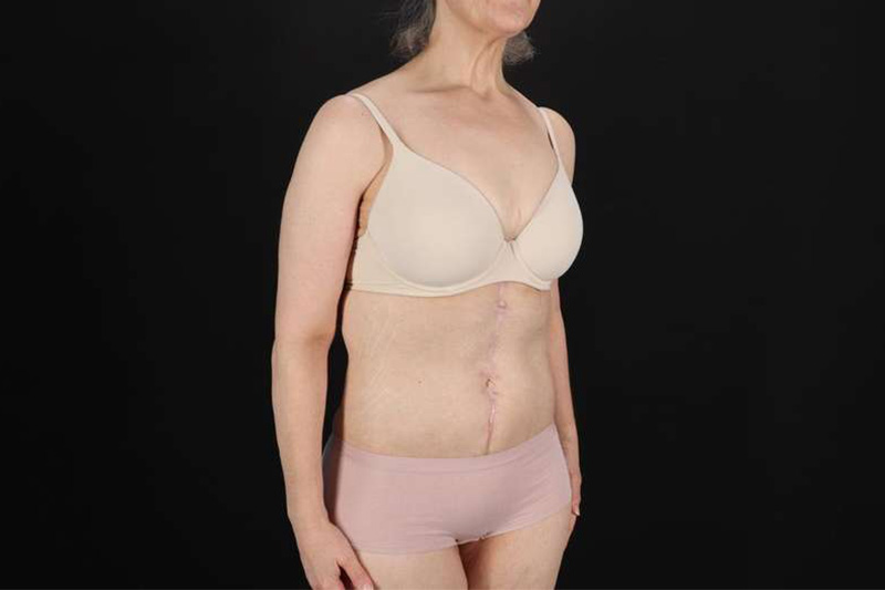 Fleur De Lis Circumferential Body Lift Before & After Patient #4249