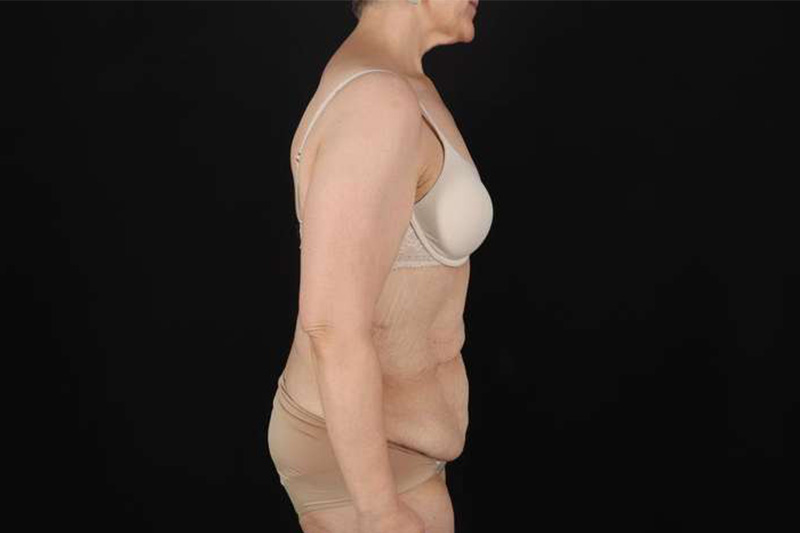 Fleur De Lis Circumferential Body Lift Before & After Patient #4249