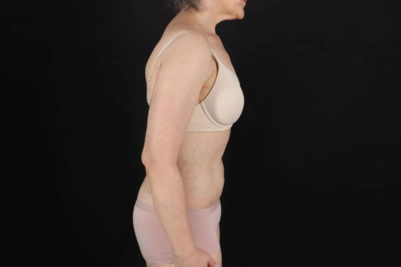 Fleur De Lis Circumferential Body Lift Before & After Patient #4249