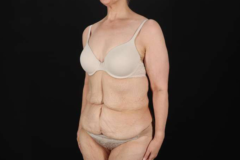 Fleur De Lis Circumferential Body Lift Before & After Patient #4249