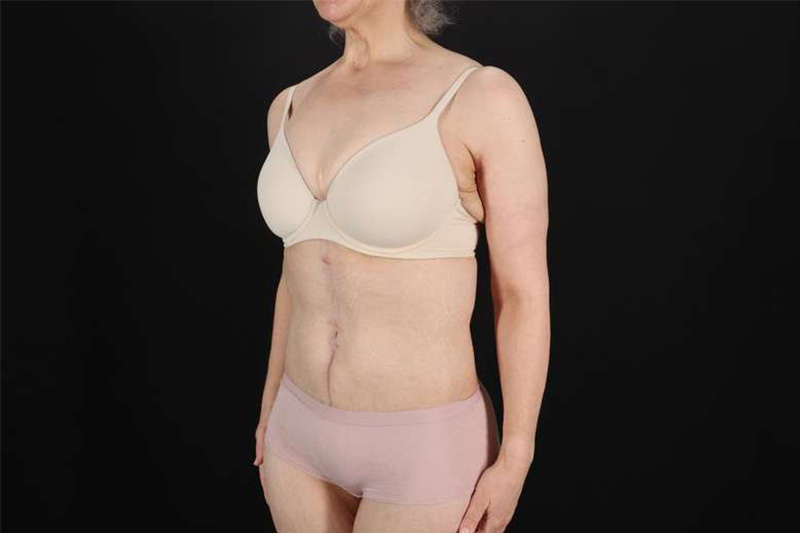 Fleur De Lis Circumferential Body Lift Before & After Patient #4249