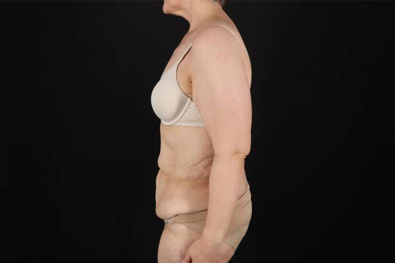 Fleur De Lis Circumferential Body Lift Before & After Patient #4249