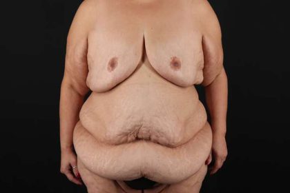 Fleur De Lis Circumferential Body Lift Before & After Patient #4301