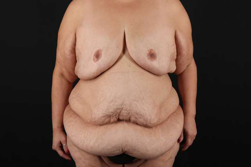 Fleur De Lis Circumferential Body Lift Before & After Patient #4301