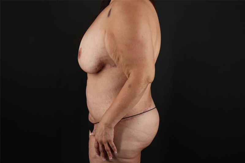 Fleur De Lis Circumferential Body Lift Before & After Patient #4301