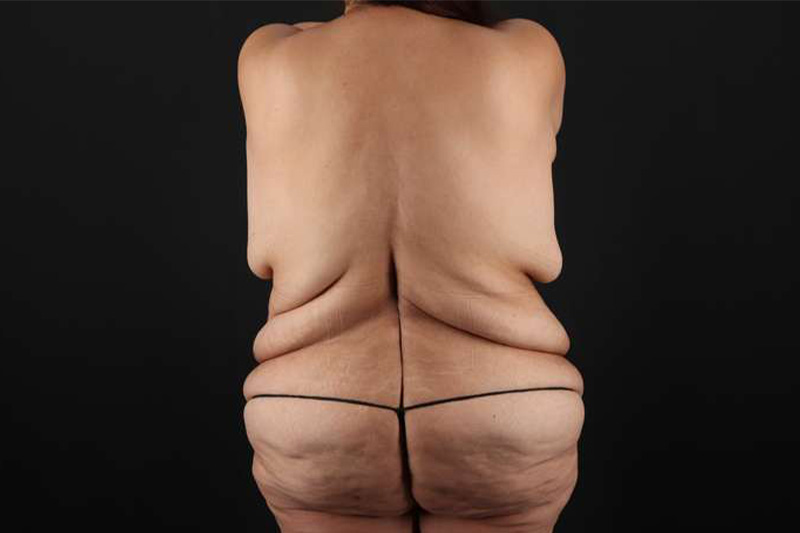 Fleur De Lis Circumferential Body Lift Before & After Patient #4301
