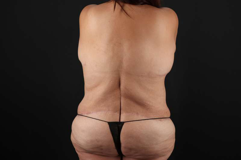 Fleur De Lis Circumferential Body Lift Before & After Patient #4301