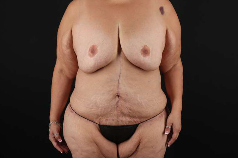 Fleur De Lis Circumferential Body Lift Before & After Patient #4301