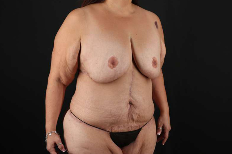 Fleur De Lis Circumferential Body Lift Before & After Patient #4301