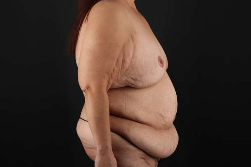 Fleur De Lis Circumferential Body Lift Before & After Patient #4301