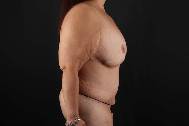 Fleur De Lis Circumferential Body Lift Before & After Patient #4301