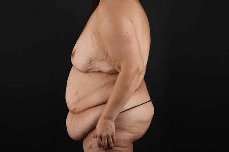 Fleur De Lis Circumferential Body Lift Before & After Patient #4301