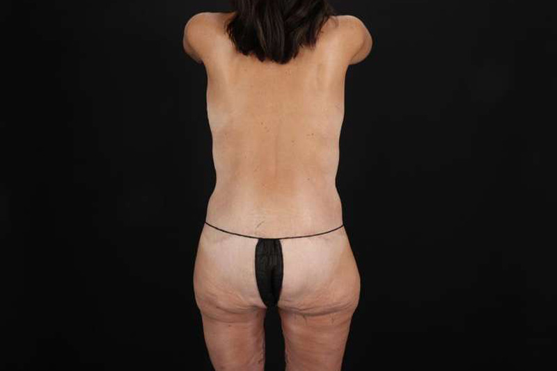 Fleur De Lis Circumferential Body Lift Before & After Patient #4314