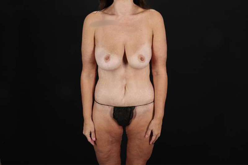 Fleur De Lis Circumferential Body Lift Before & After Patient #4314