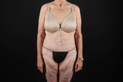 Fleur De Lis Tummy Tuck Before & After Patient #4327