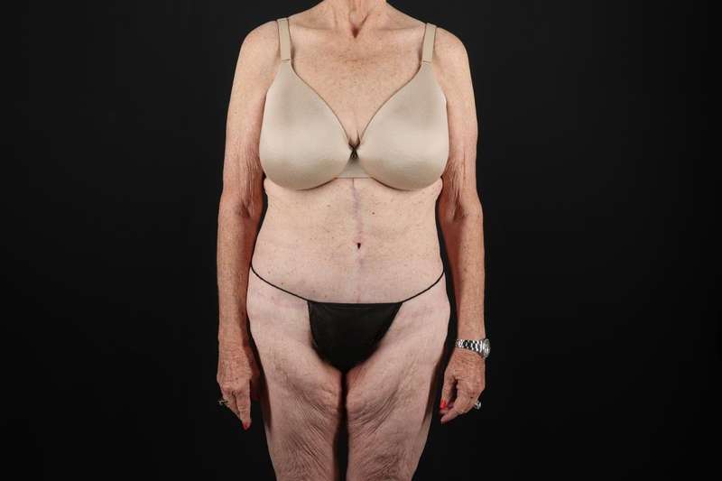 Fleur De Lis Tummy Tuck Before & After Patient #4327