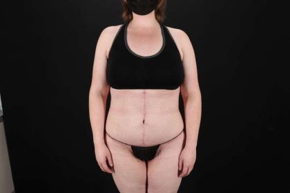 Fleur De Lis Tummy Tuck Before & After Patient #4340
